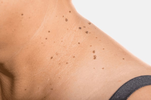 Are you looking for easy skin tag removal Ladywood - then contact Spire today!