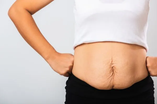 Image of a woman's stomach after weight loss with sagging skin following a gastric band Ladywood