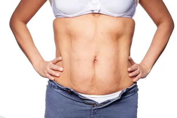 sagging skin on woman's stomach after weight loss injections Ladywood