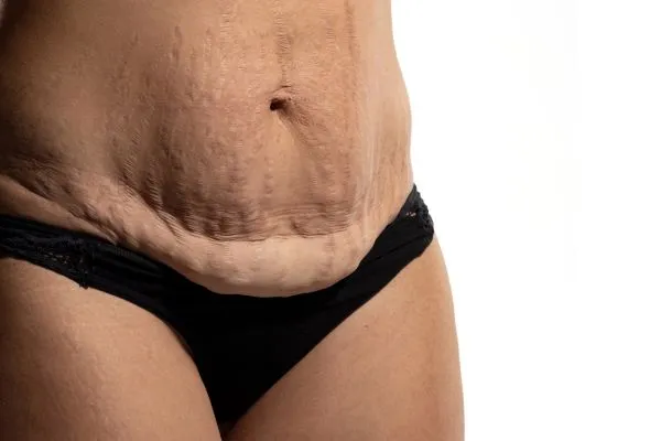 Image of womans stomach after weight loss injections Ladywood showing saggy skin